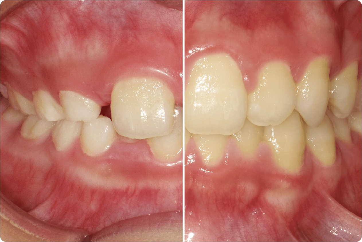 歯並びは成長に影響します！