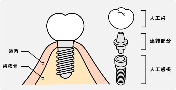 インプラントとは