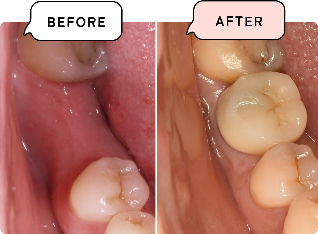 インプラントとは