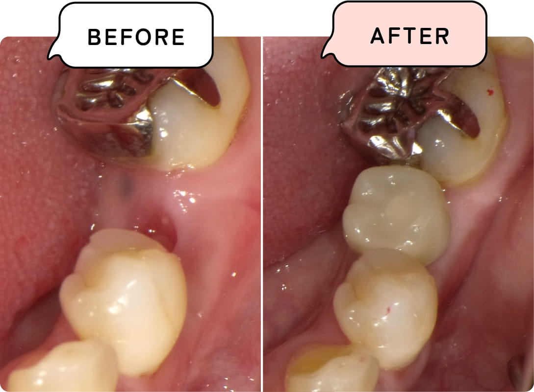 インプラントとは