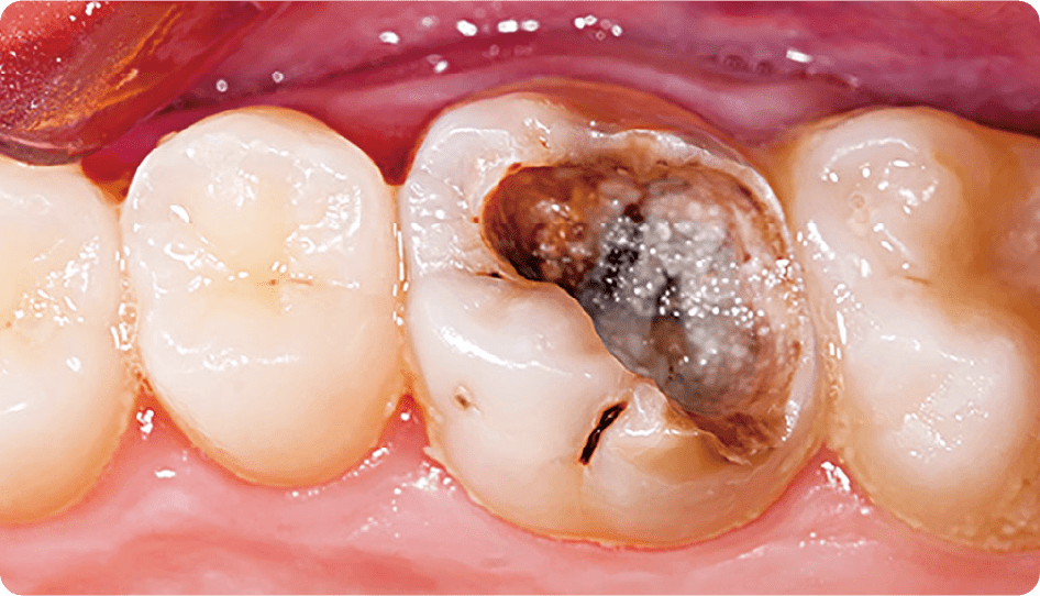 むし歯
