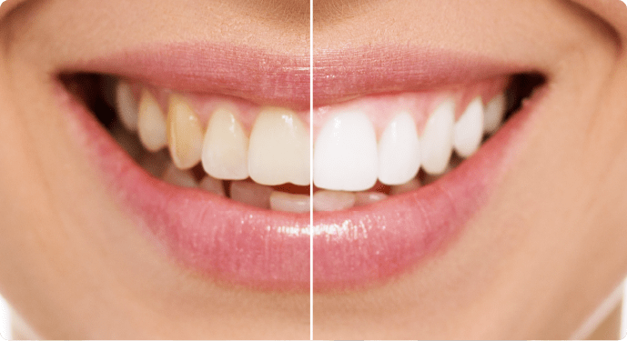 ホワイトニング